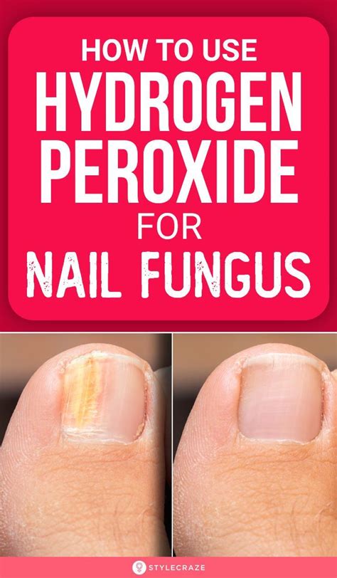 Hydrogen Peroxide Toenail Fungus Before And After Lvandcola
