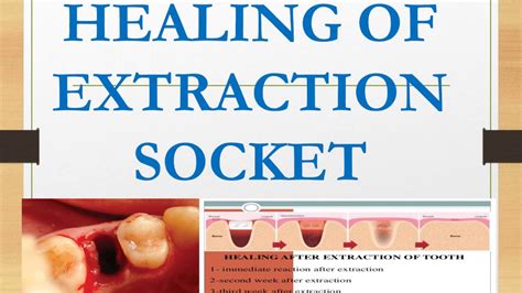Healing Of Extraction Socket Oral Pathology Youtube