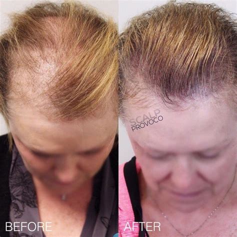 Smp For Women Experiencing Hair Loss And Thinning Scalp Provoco