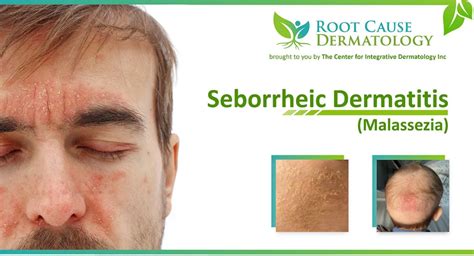 How To Prevent Seborrheic Dermatitis Hair Loss Root Cause Dermatology