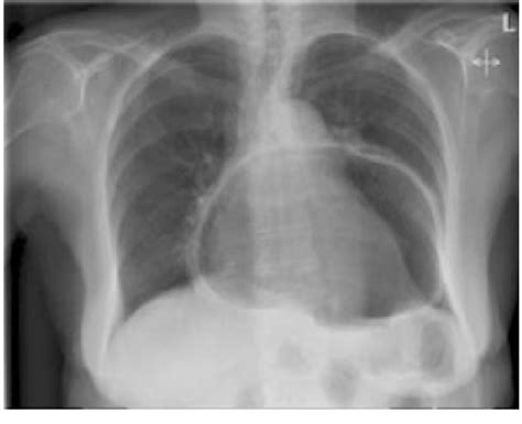 Chest X Ray Cxr Of Acute Paraesophageal Hernia Without Ng Tube