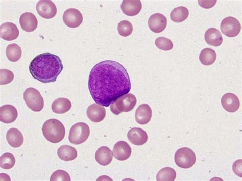 Hematology Challenge Can You Identify These Two Leukocytes