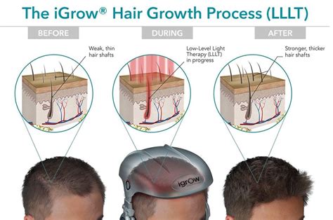 Igrow Laser Hair Growth System Mcgrath Medical