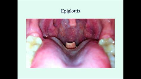Que Es La Epiglotis