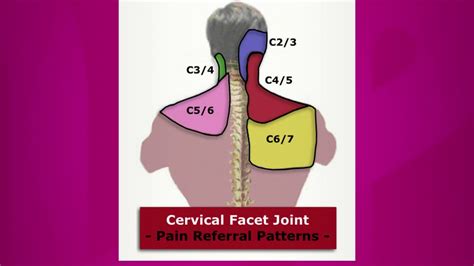 Cervical Facet Referral Patterns Bead Pattern Free