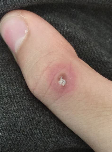 Möglicherweise unterliegen die inhalte jeweils zusätzlichen bedingungen. Ich liess mir die Warze entfernen, aber plötzlich erschien ...
