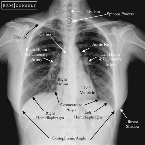 Chest Xray Radiograph Ap View Image Medical Knowledge Radiology