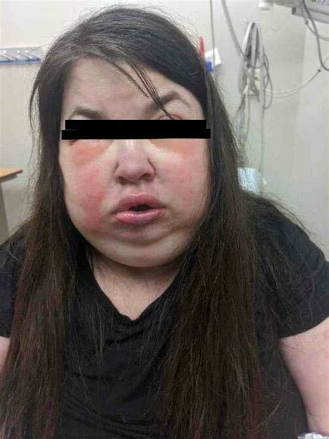 The Patient Had Extensive Face And Neck Swelling On Presentation To The