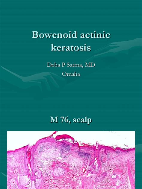 Bowenoid Actinic Keratosis 1 Pdf
