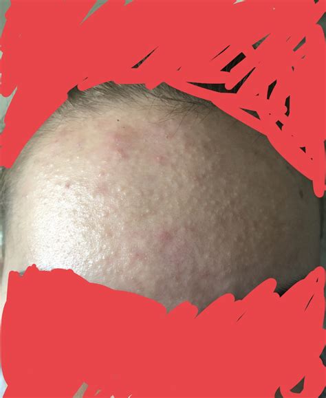 Acne Bumps On My Forehead General Acne Discussion Forum