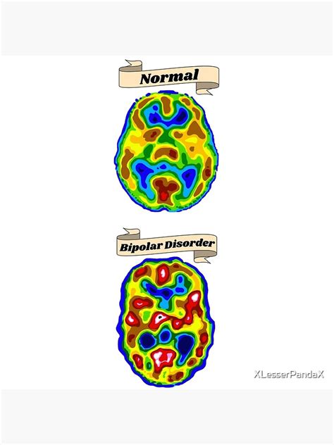 Copy Of Normal Vs Bipolar Brain Scan Poster By Xlesserpandax Redbubble