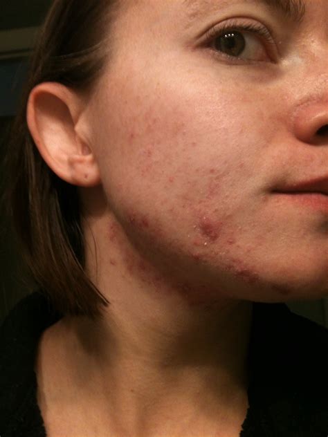 My Amazing Discovery How I Finally Got Rid Of My Severe Acne And You Can Too Trusper