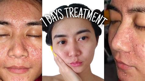 How I Cleared My Acne Acne Story 7 Days Treatment Youtube