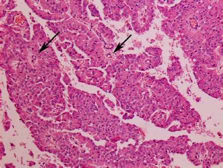 Right Testicle Interstitial Leydig Cell Tumor Numerous Cells With