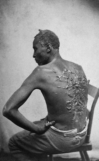 Shocking Photos Of Escaped Slave Gordon Showing His Scarred Back At A