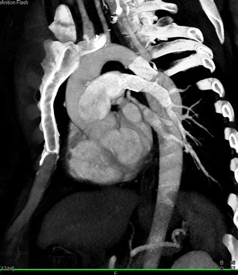 Coarctation Of The Aorta Repaired With Stent Vascular Case Studies
