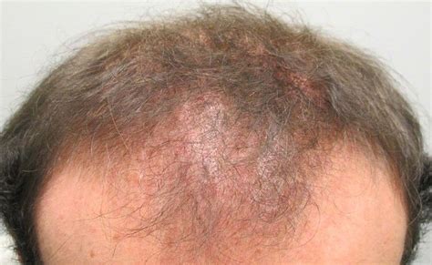Scarring Vs Non Scarring Alopecia Causes And Treatments Scarring