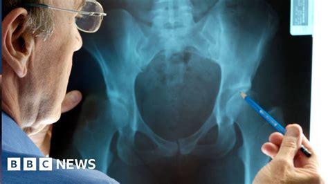 Most Hip And Knee Replacements Last Longer Than Thought Bbc News