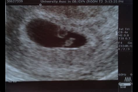 Your baby may look like a little tadpole more than a little human at this point. 6 week ultrasound ??? - BabyCenter