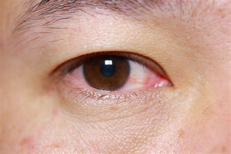Treatments For Pink Eye Facty Health