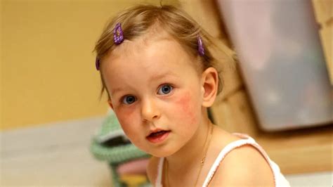 Dermatita Atopic La Copii Cum O Inem Sub Control Solu Ii Pentru O