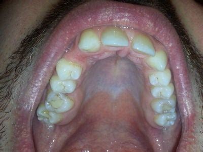 Check spelling or type a new query. Can I use Invisalign for overbite, crossbite and shifted ...