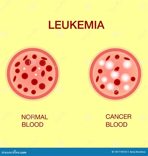 Leukemia Or Leukaemia Cartoon Vector 48074147