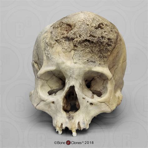 Shop the latest female bones deals on aliexpress. Human Female Skull, Meningioma - Bone Clones, Inc ...