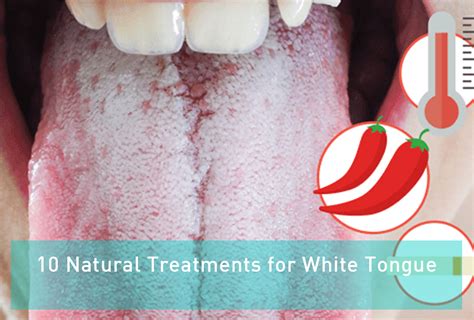 10 Natural Treatments For White Tongue Çok Bilenler