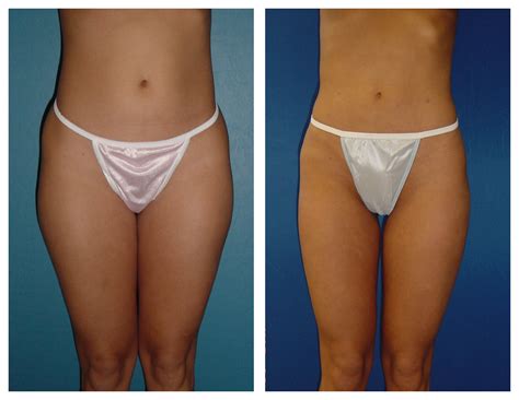 Female Inner Outer Thighs Liposuction By Dr William Hall Before And After Photos Call Us