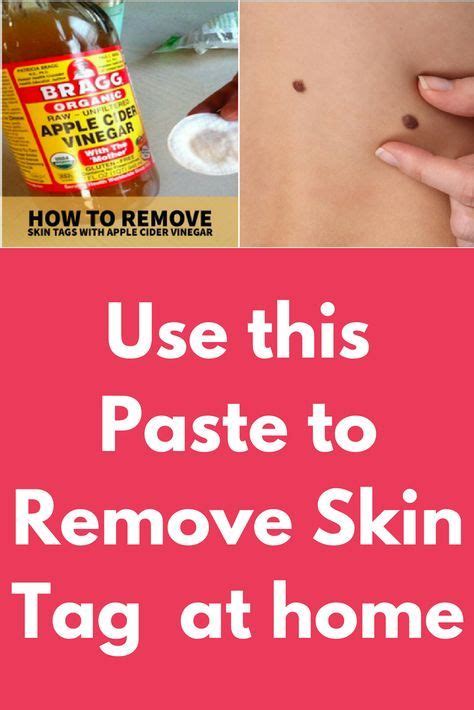 use this paste to remove skin tag at home this home remedy will remove skin tag easily a… skin