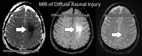 Diffuse Axonal Injury Axonal Injury Diffuse