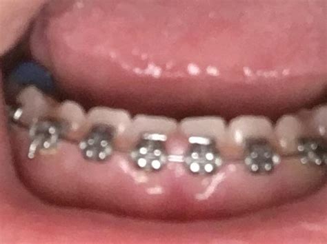 Gums Are Swollen In Between 2 Front Brackets Its Been Like This For 2