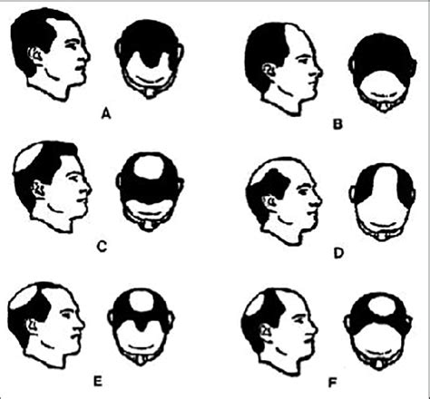 Koos Classification Of Male Pattern Baldness A M Type B C Type