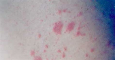 Tremetskicom Fungal Skin Rash Treatment Best Information On