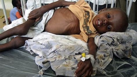 Malnutrition Kills 2 Million Kids A Year Cbc News