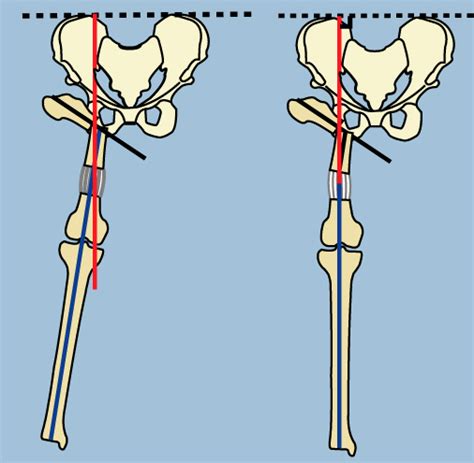 Pelvic Support Osteotomy Paley Orthopedic And Spine Institute