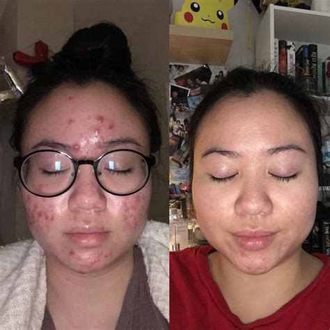 Before After My Cystic Acne Journey R Skincareaddiction