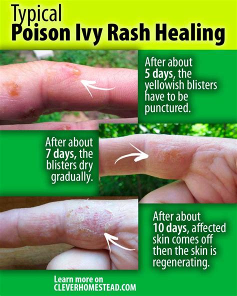 Poison Ivy Poison Oak And Poison Sumac Relief Treatment And Healing