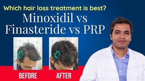 Minoxidil Vs Finasteride Vs Prp Therapy With Results Which Is The Best Hair Regrowth Treatment