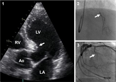 Folfox Chemotherapy As A Cause Of Ventricular Septal Rupture After
