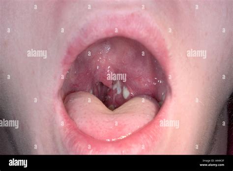 Strep Throat Infection Stock Photo Alamy