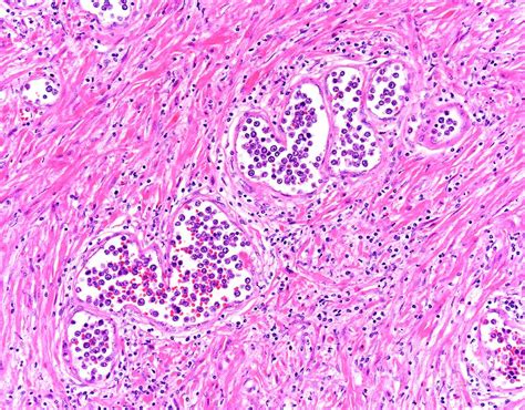 Intravascular Large B Cell Lymphoma Photograph By Webpathologyscience