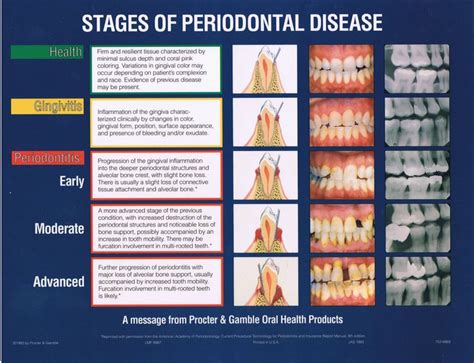 Stages Of Periodontal Disease Dentistry Dental Hygiene School