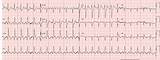 Images of Afib And Sleeping On Left Side