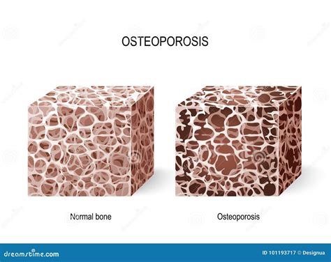 Osteoporosis Bone Tissue Stock Vector Illustration Of Loss 101193717