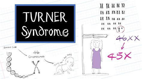 Turner Syndrome Causes Symptoms And Treatment Healthsketch