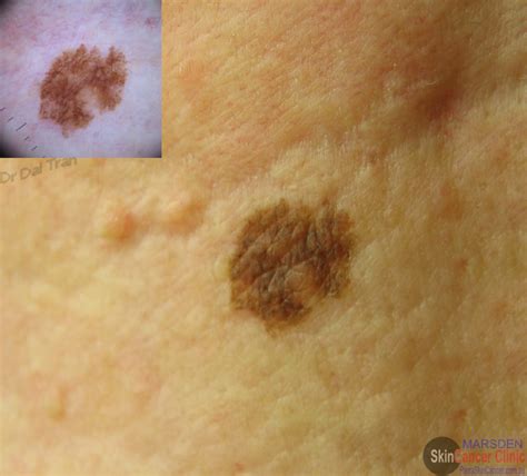 Skincancerphysician Skin Cancer Melanoma