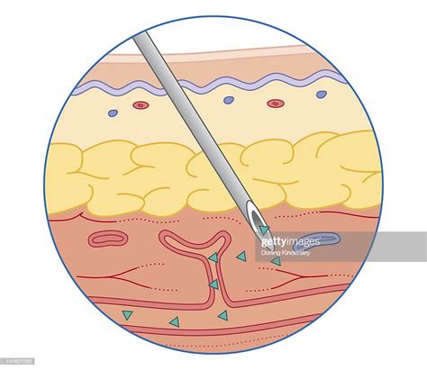 Cross Section Biomedical Illustration Of Intramuscular Drug Injected