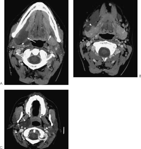 Simple Ranula Radiology Key